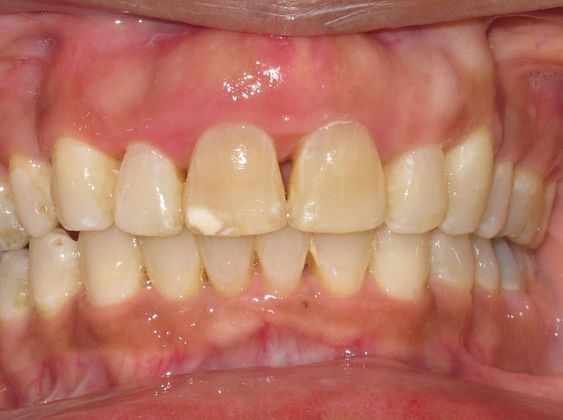 Periodontics and Braces Over Bite - After