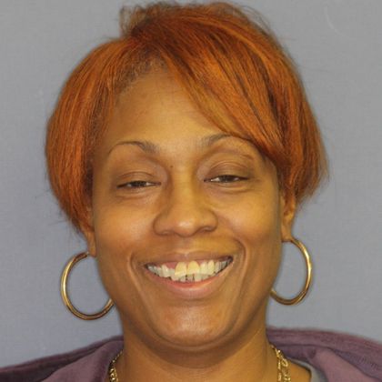 Periodontics and Braces: Over Bite - Before