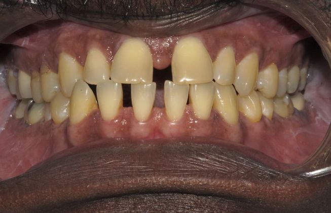 Senior: Spacing - Before