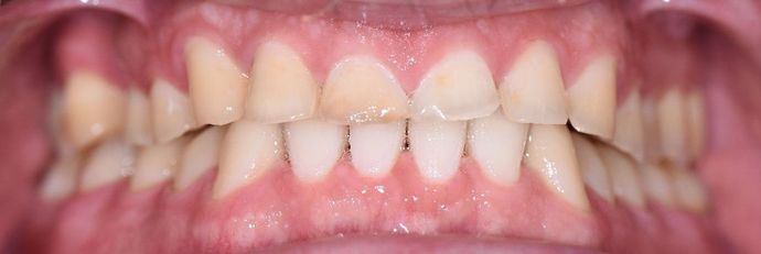 Tooth-colored Fillings Case 12 - Victoria, TX - Before