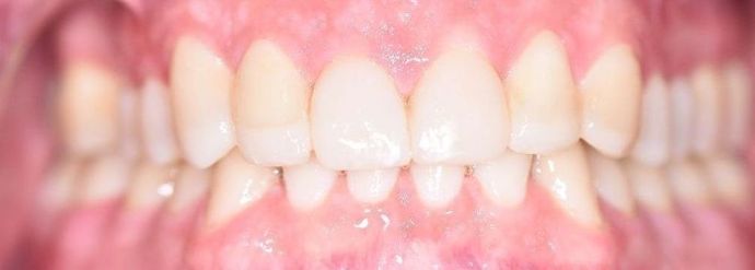 Tooth-colored Fillings Case 12 - Victoria, TX - After