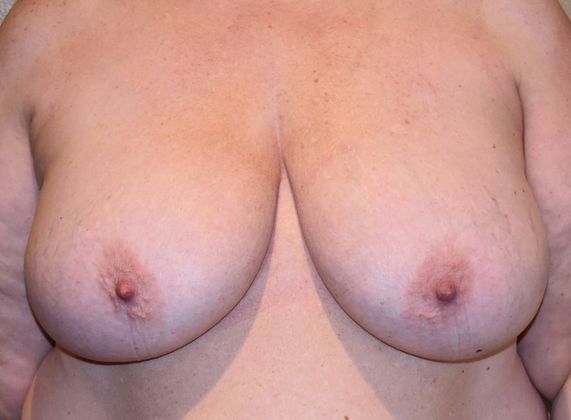 Breast Reduction Case 92 - Before