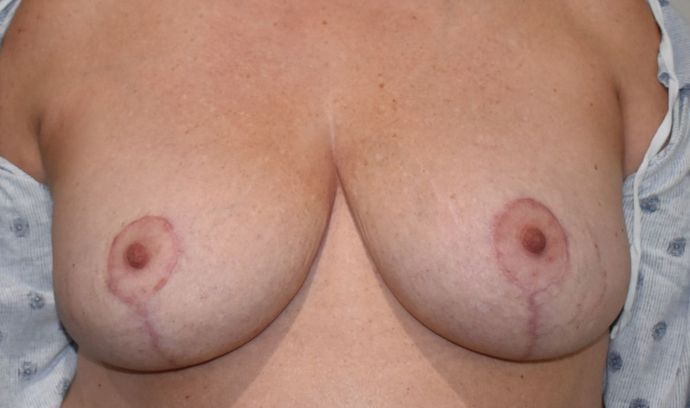 Breast Reduction Case 92 - After