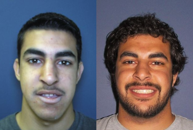 Orthognathic Surgery/Jaw Surgery Cases