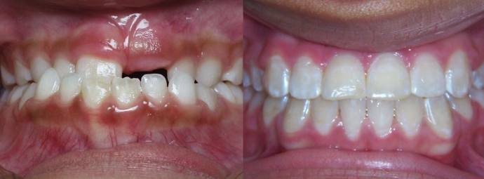 Under Bite with NO Surgery Cases