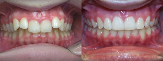 Deep Bite - Overlapping Teeth Cases