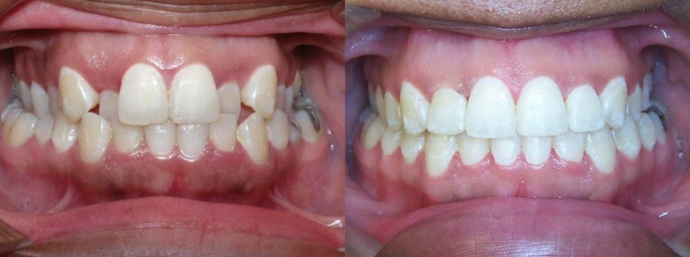 Narrow Arch - Narrow Smile Cases