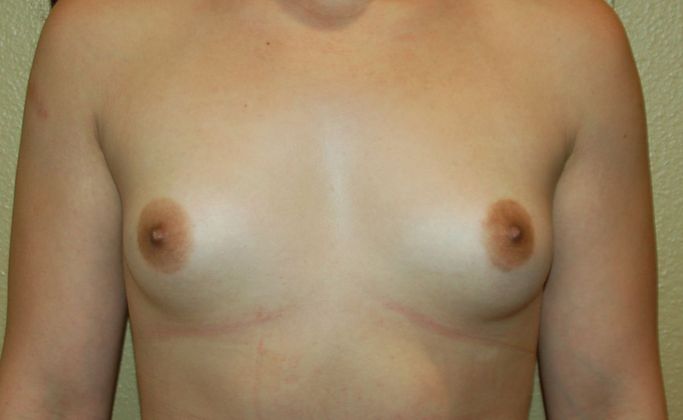 Breast Augmentation Case 589 - Before