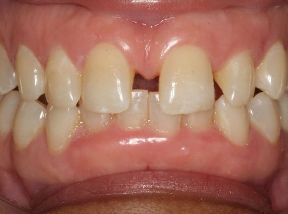 Amazing Smiles: Senior - Before