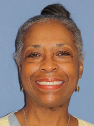 Amazing Smiles: Senior - After