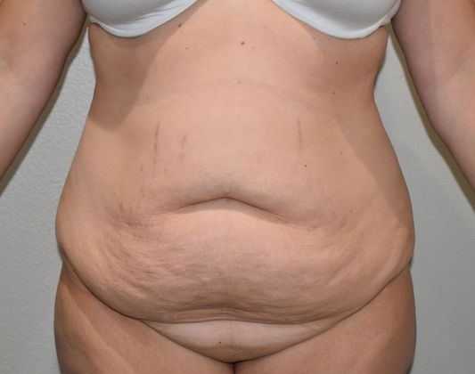 Tummy Tuck (Abdominoplasty): Case 224 - Before