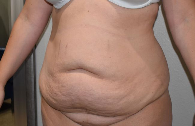 Tummy Tuck (Abdominoplasty): Case 224 - Before