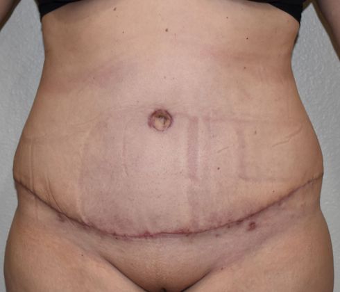 Tummy Tuck (Abdominoplasty): Case 224 - After
