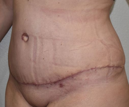 Tummy Tuck (Abdominoplasty): Case 224 - After