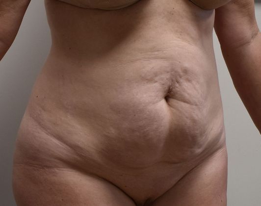 Tummy Tuck (Abdominoplasty): Case 225 - Before
