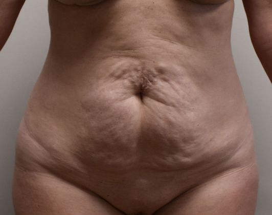 Tummy Tuck (Abdominoplasty): Case 225 - Before