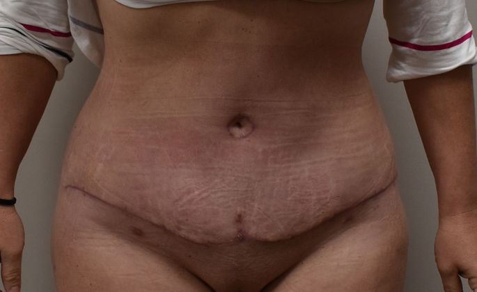 Tummy Tuck (Abdominoplasty): Case 225 - After