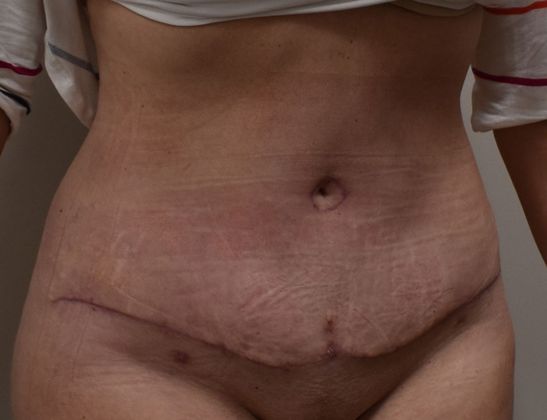 BodyTite: Case 2 - After