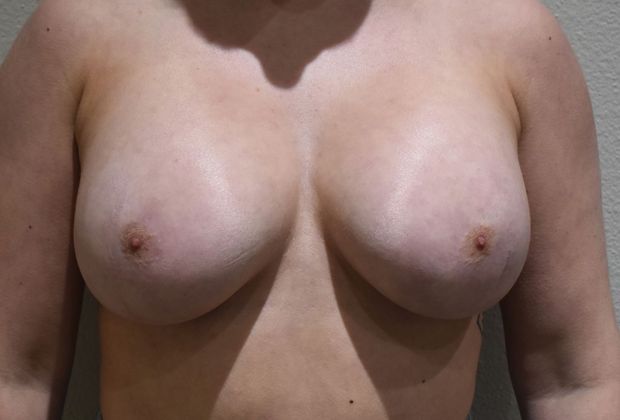 Breast Augmentation Case 591 - After