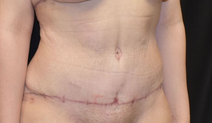 Tummy Tuck (Abdominoplasty): Case 226 - After