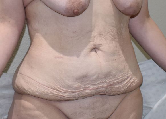 Tummy Tuck (Abdominoplasty): Case 226 - Before