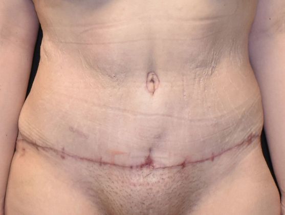 Massive Weight Loss : Case 68 - After