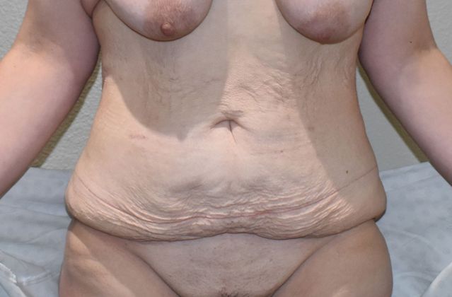 Massive Weight Loss : Case 68 - Before