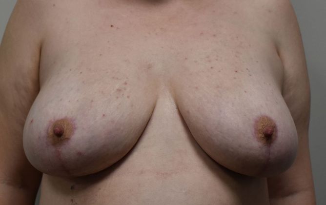 Breast Lift (Mastopexy) Case 86 - After