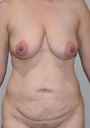 Mommy Makeover Case 153 - Before