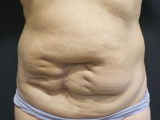 Tummy Tuck Case 30 - Before