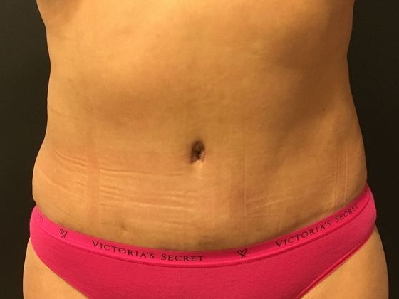 Tummy Tuck Case 30 - After