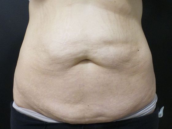 Tummy Tuck Case 32 - Before
