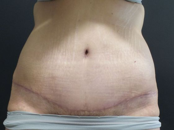 Tummy Tuck Case 32 - After