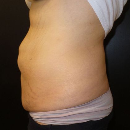 Tummy Tuck: Case 32 - Before