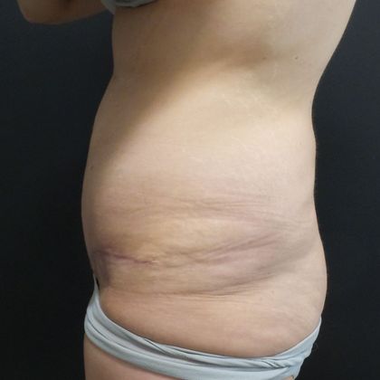 Tummy Tuck: Case 32 - After