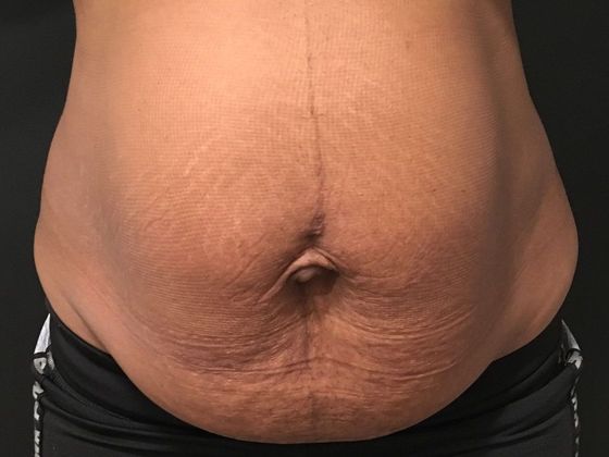 Tummy Tuck Case 33 - Before