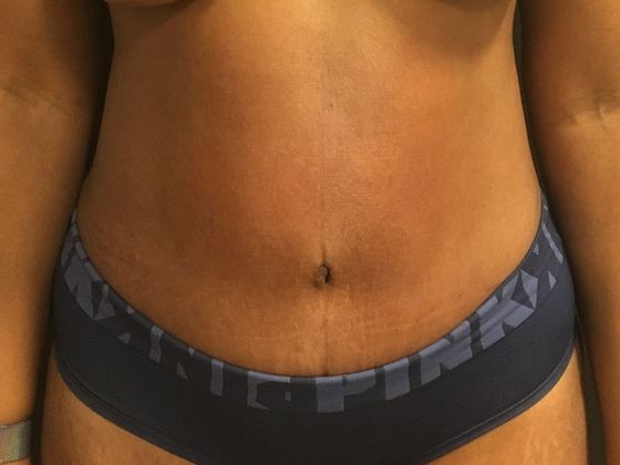 Tummy Tuck Case 33 - After