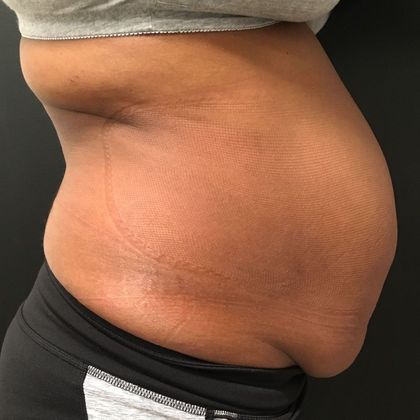 Tummy Tuck: Case 33 - Before