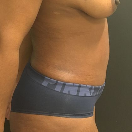 Tummy Tuck: Case 33 - After