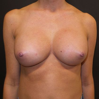 Breast Augmentation Case 16 - After