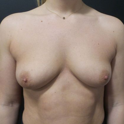 Breast Augmentation Case 17 - Before