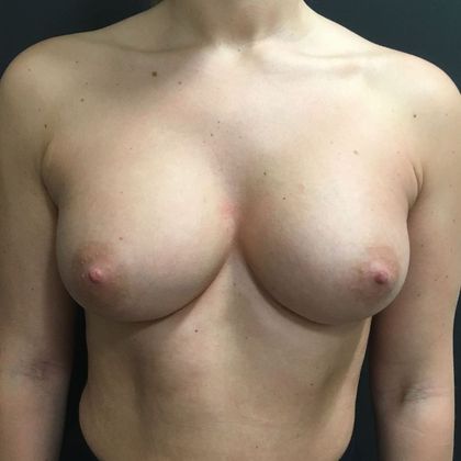Breast Augmentation Case 17 - After