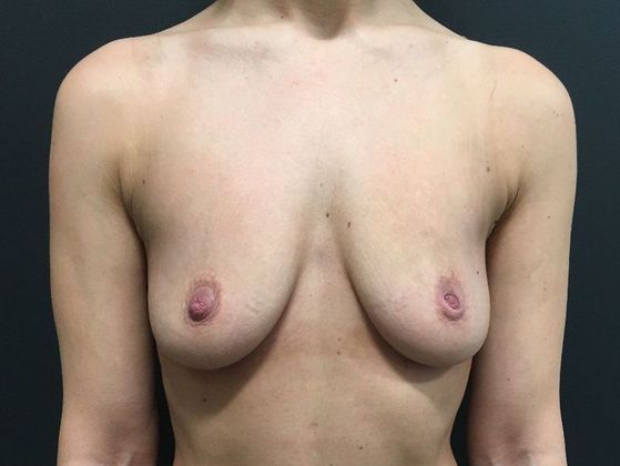 Breast Augmentation Case 18 - Before