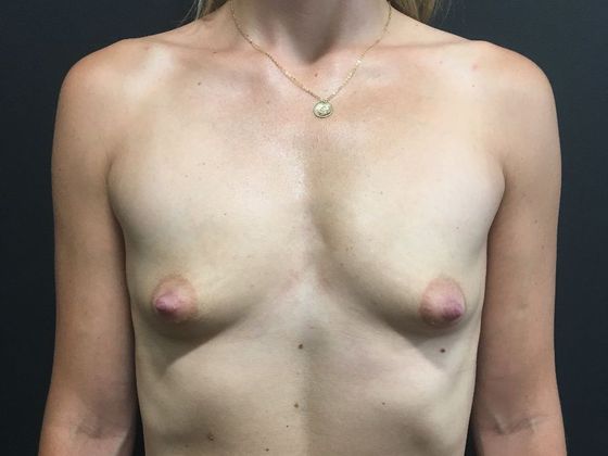 Breast Augmentation Case 19 - Before