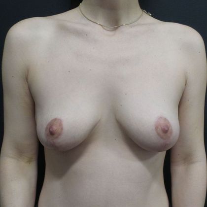 Breast Lift Case 1 - After