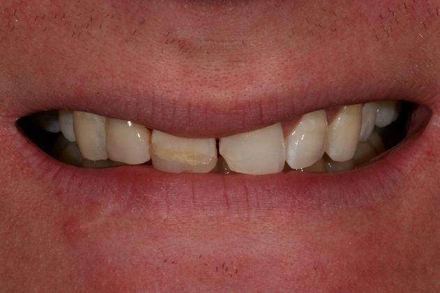 Dental Implants: Case 3 - Before
