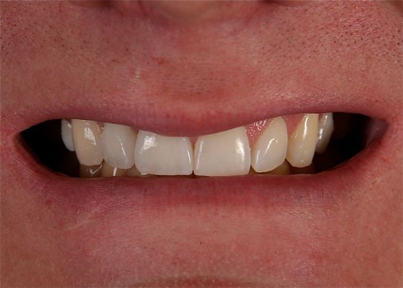 Dental Implants: Case 3 - After