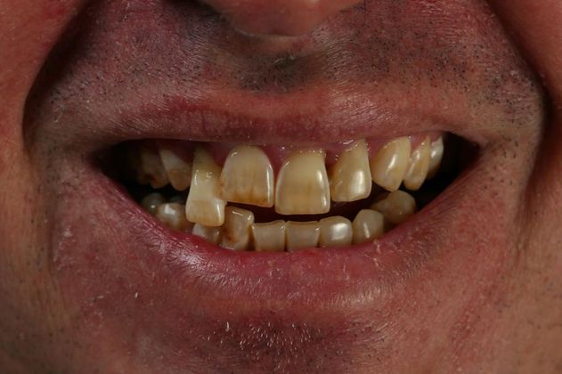 Dental Implants: Case 5 - Before