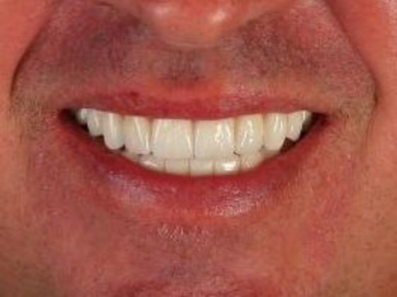 Dental Implants: Case 5 - After