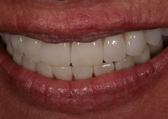 Dental Implants: Case 6 - After